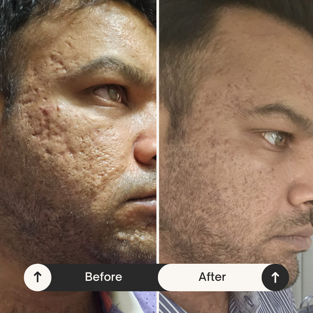 Client before and after — cystic acne healed through gut-first nutrition